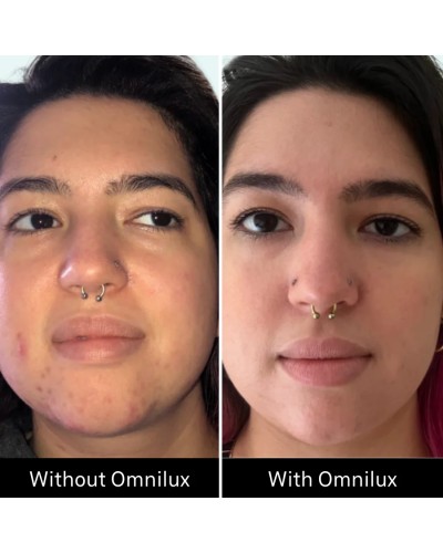 Omnilux Clear - Maschera LED Viso Acne