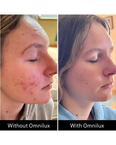 Omnilux Clear - Maschera LED Viso Acne