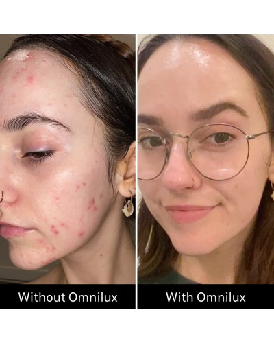 Omnilux Clear - Maschera LED Viso Acne