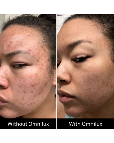 Omnilux Clear - Maschera LED Viso Acne