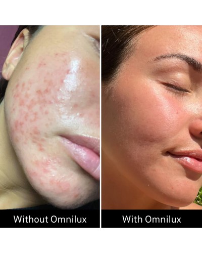 Omnilux Clear - Maschera LED Viso Acne
