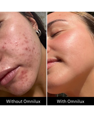 Omnilux Clear - Maschera LED Viso Acne