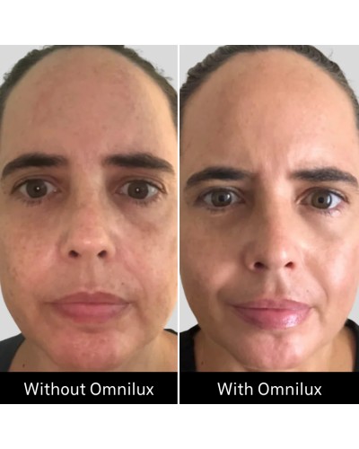 Omnilux Contour - Maschera LED Viso Rughe